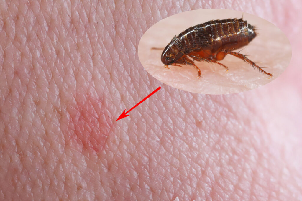 A red bite mark from a flea biting a human. Though they can bite, they are unable to live on humans themselves.